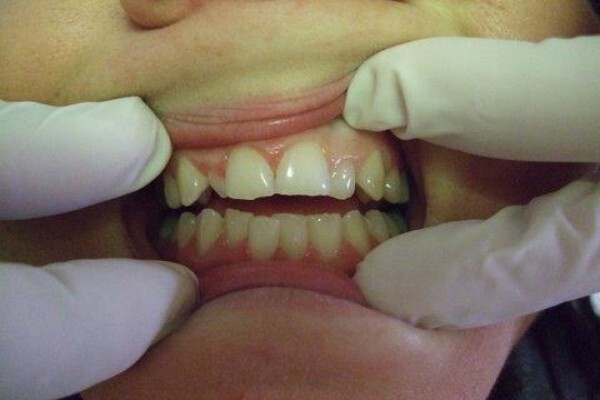 Tooth Implant