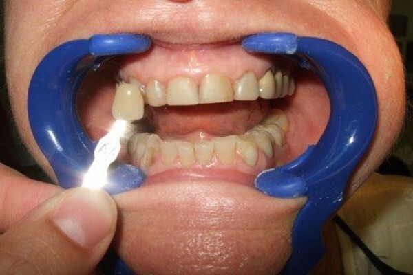 Tooth Implant
