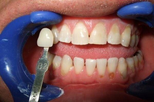 Tooth Implant