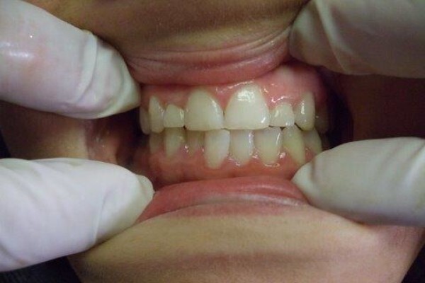Tooth Implant