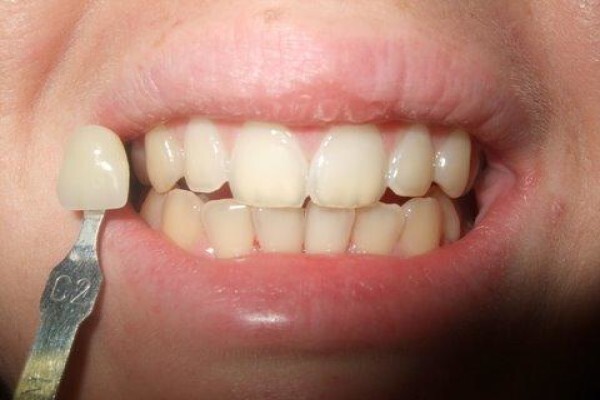 Tooth Implant