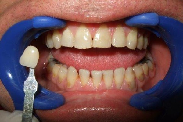 Tooth Implant