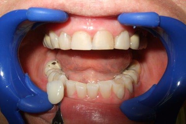 Tooth Implant