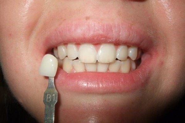 Tooth Implant