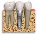 The Specialist Dental Implant Centre (Specialist Prosthodontist) Bchd, Mchd