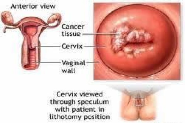 India Cancer Surgery Site