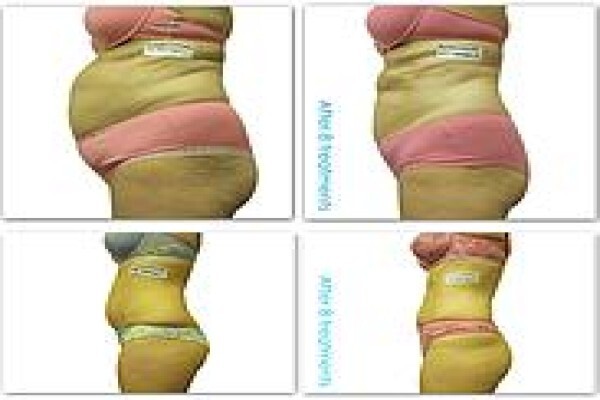 I-Lipo Lazer Centre