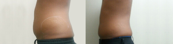 Reshape Slimming