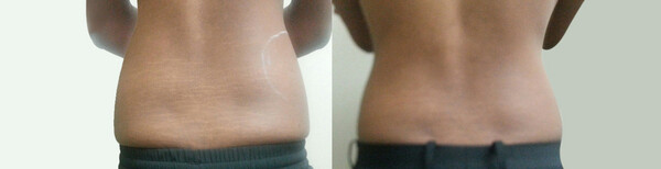 Reshape Slimming