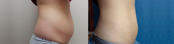 Reshape Slimming
