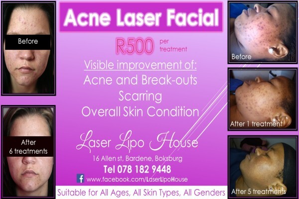 Laser Lipo House