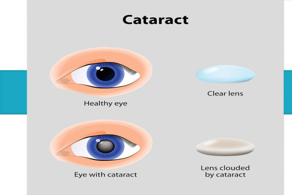 Dr. Sachin Bawa Cataract & Vision Clinic