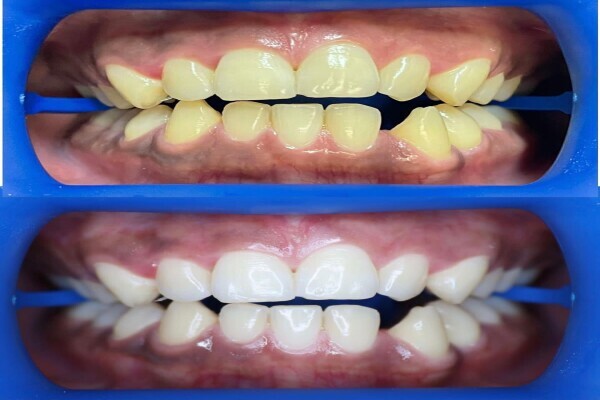 Zoom Whitening South Africa