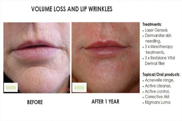Skin Renewal