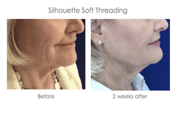 Skin Renewal