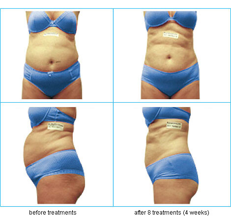 I-Lipo Lazer Centre