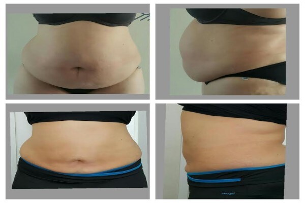 Laserlipo SA