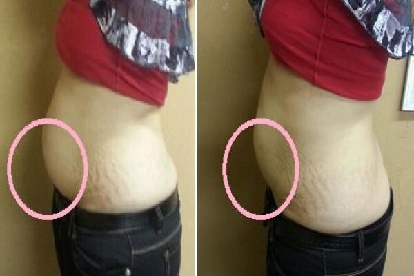 Laserlipo SA