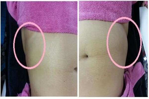 Laserlipo SA