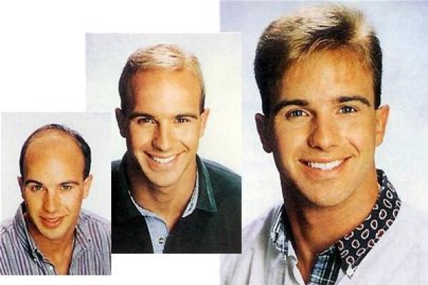 Sirs Hair Replacement & Clinic