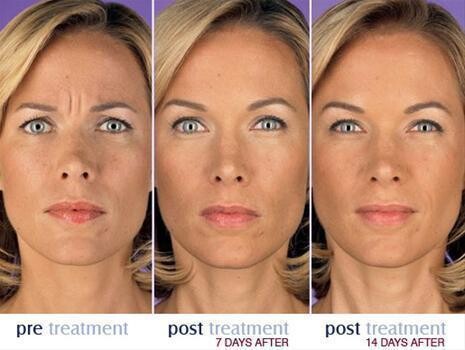 Botox Institute Sandton