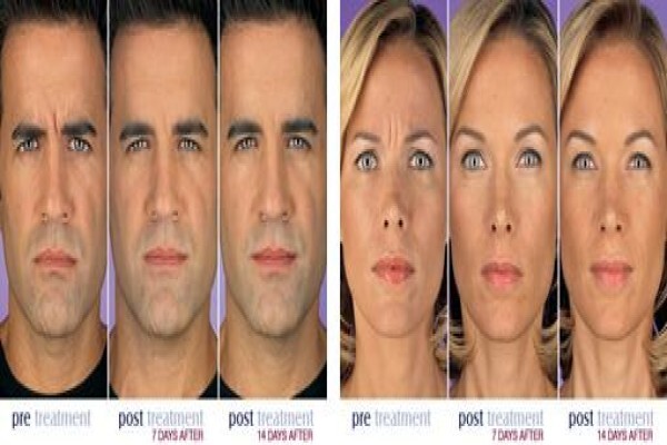 Botox Institute Sandton