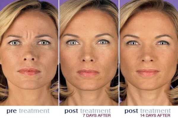 Botox Institute Sandton