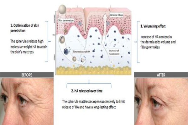 Cosmesotherapie