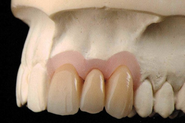 Metal Free Dental