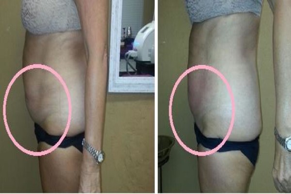 Laserliposa