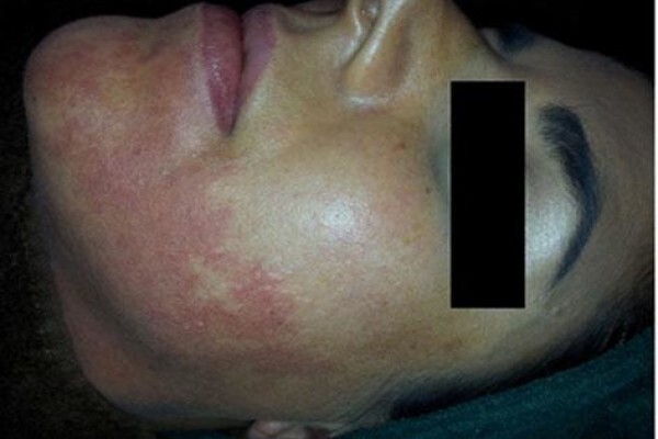Advanced Dermatology