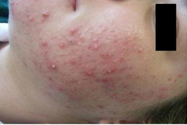 Advanced Dermatology
