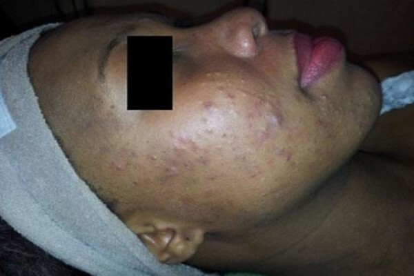 Psoriasis