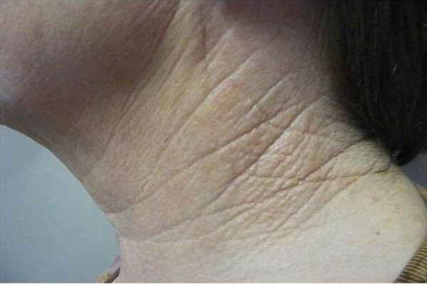 Psoriasis