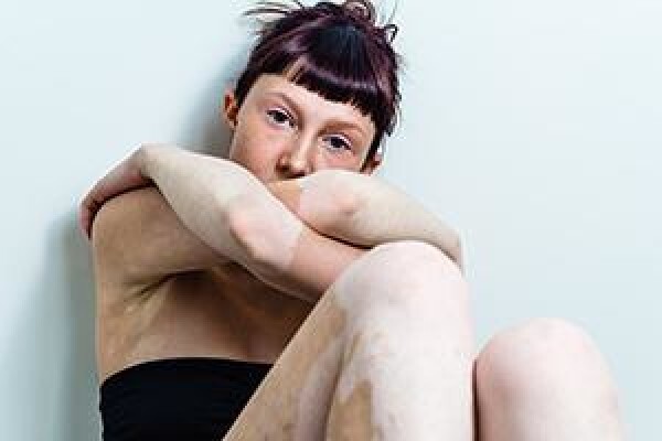 Psoriasis
