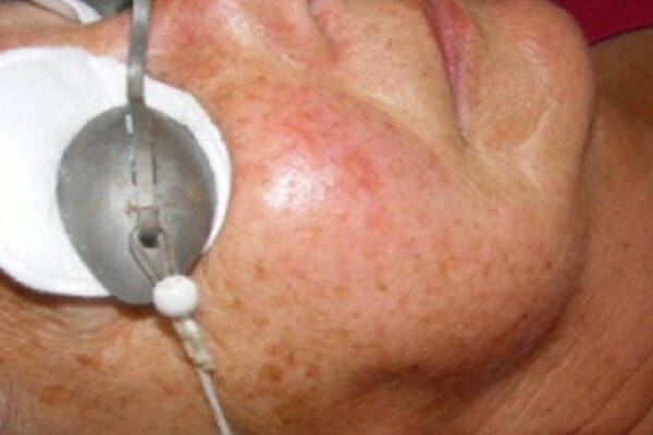 Psoriasis