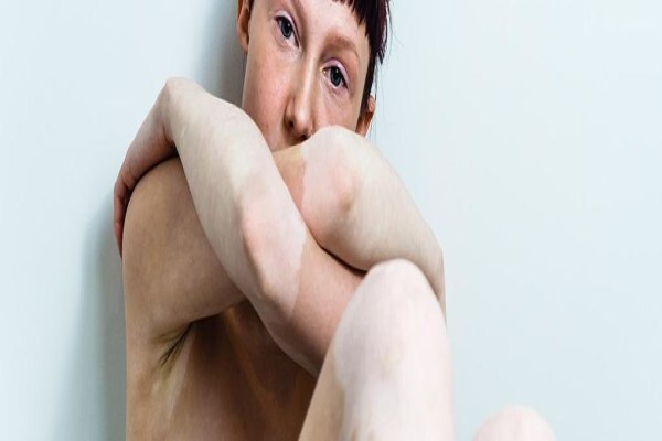 Psoriasis