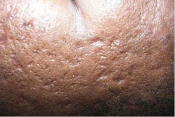 Psoriasis