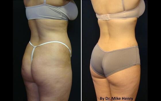 Dr.Mike Henry, Benoni.