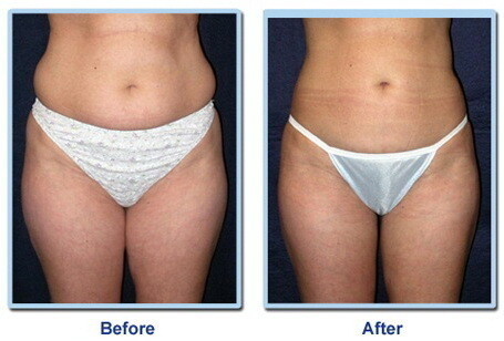 Laser Lipo Cape Town - Nubody Nuskin
