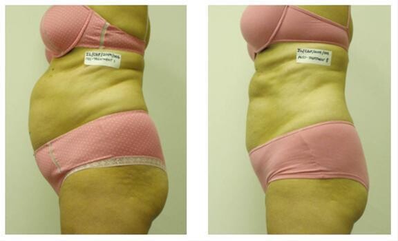 I–Lipo Somerset West