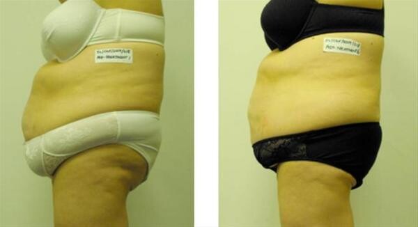 I–Lipo Somerset West