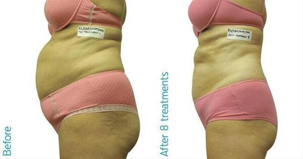 I-Lipo Bedfordview