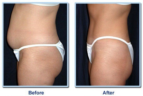 Laser Lipo Cape Town - Nubody Nuskin