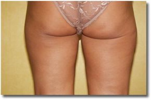 Laser Lipo