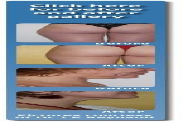 Laser Lipo