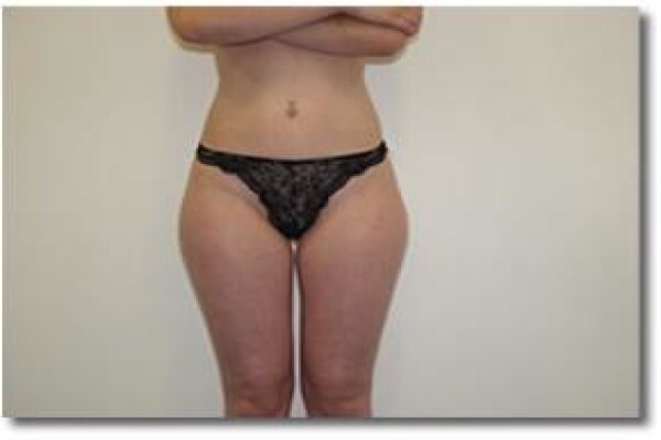 Laser Lipo