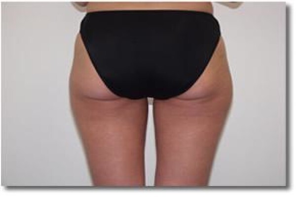 Laser Lipo
