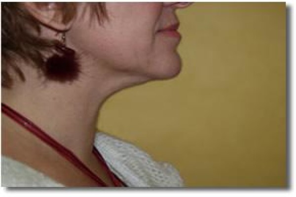 Laser Lipo