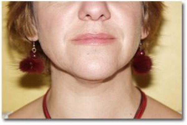 Laser Lipo